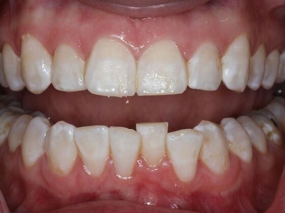 Invisalign Case 20 - Before