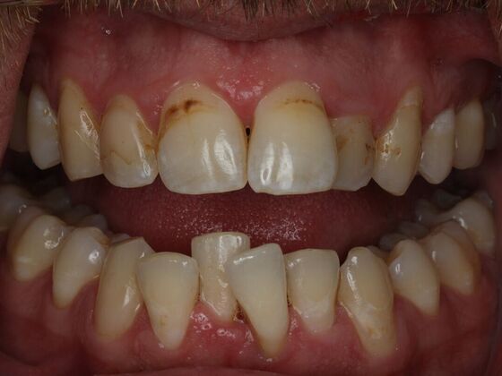 Invisalign Case 21 - Before