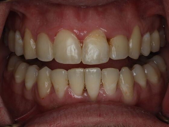 Invisalign Case 21 - After