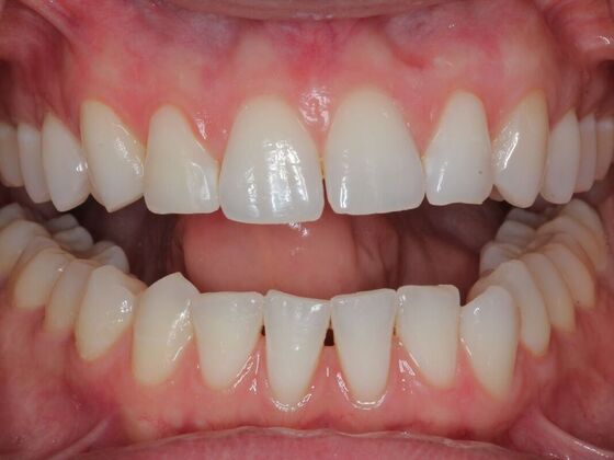 Invisalign Case 22 - Before