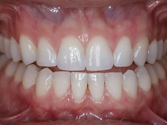 Invisalign Case 22 - After