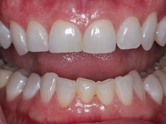 Invisalign Case 23 - Before