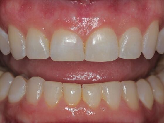 Invisalign Case 23 - After
