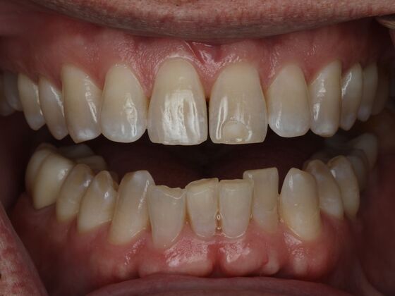 Invisalign Case 24 - Before