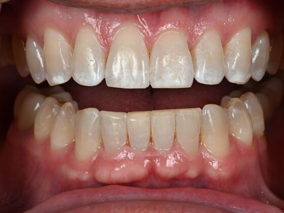 Invisalign Case 24 - After