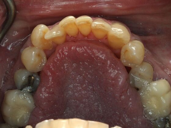 Invisalign Case 25 - Before