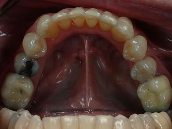Invisalign Case 25 - After