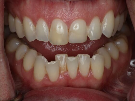 Invisalign Case 26 - Before