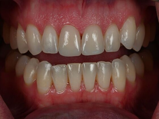 Invisalign Case 26 - After