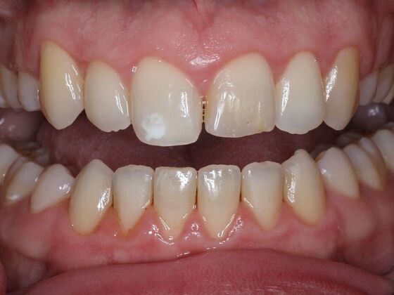 Invisalign Case 27 - Before