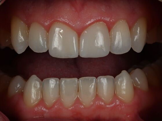 Invisalign Case 27 - After
