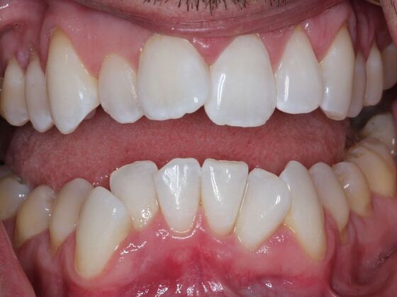 Invisalign Case 28 - Before