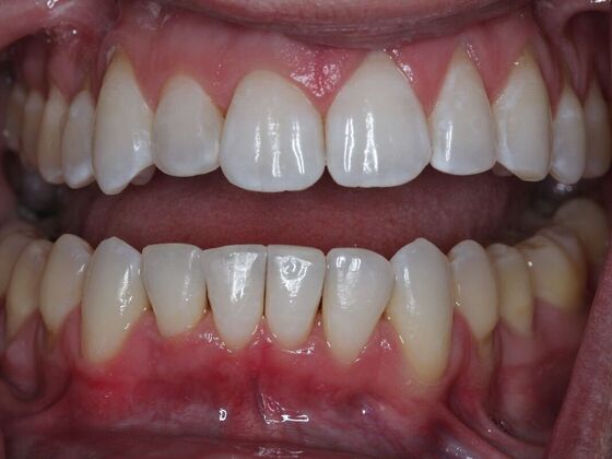 Invisalign Case 28 - After