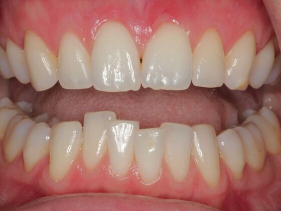 Invisalign Case 29 - Before