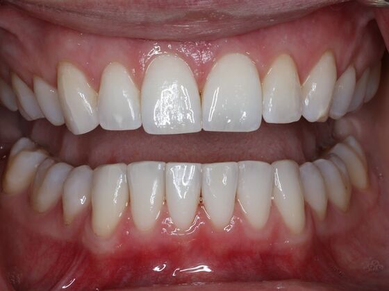 Invisalign Case 29 - After