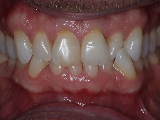 Invisalign Case 30 - Before