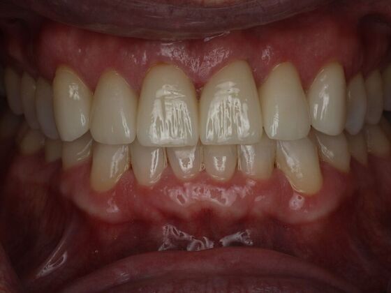 Invisalign Case 30 - After