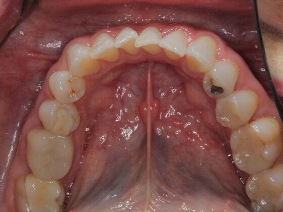 Invisalign Case 31 - Before