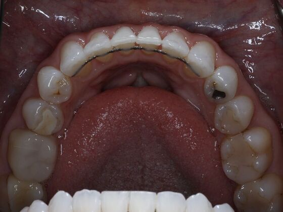 Invisalign Case 31 - After