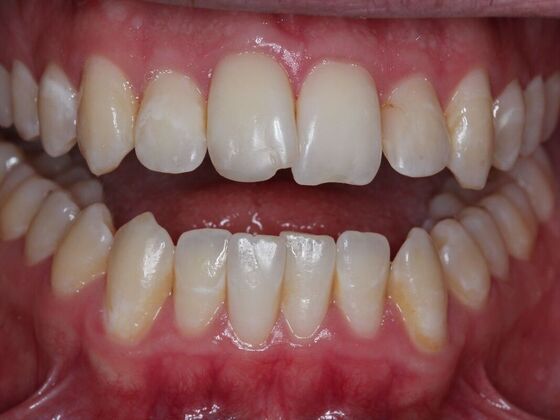 Invisalign Case 32 - Before