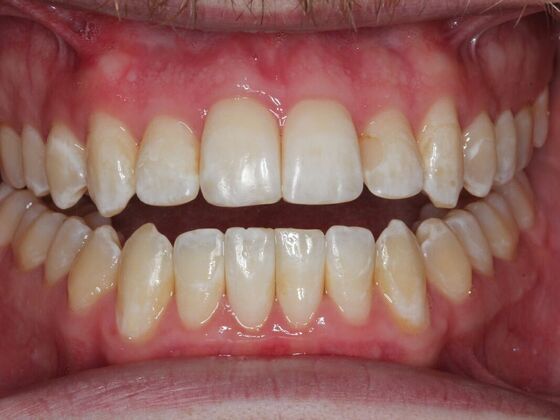 Invisalign Case 32 - After