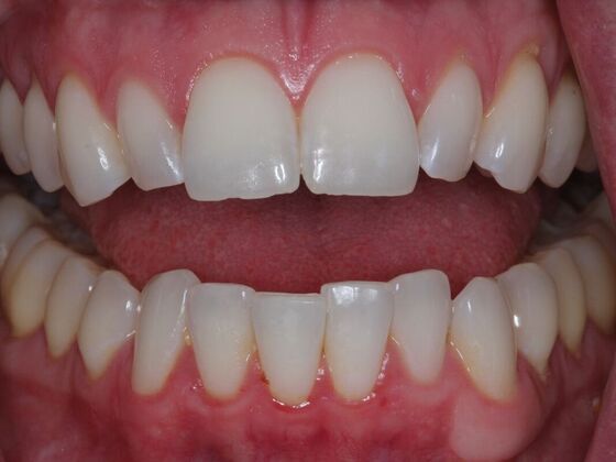 Invisalign Case 33 - Before