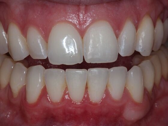 Invisalign Case 33 - After
