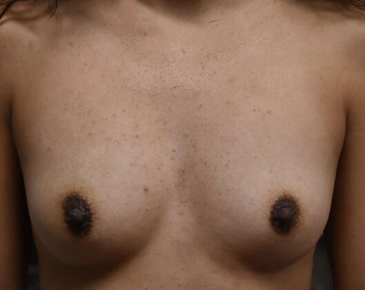 Breast Augmentation Case 6 - Before