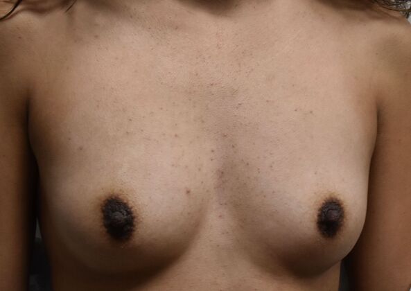 Breast Augmentation: Case 6 - Before