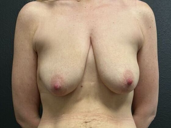 Breast Lift with Implant 650cc - Before