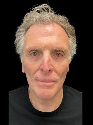 Blepharoplasty Blepharoplasty 5 - After