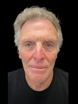 Blepharoplasty Blepharoplasty 5 - Before