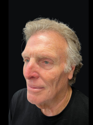 Blepharoplasty: Blepharoplasty 5 - Before