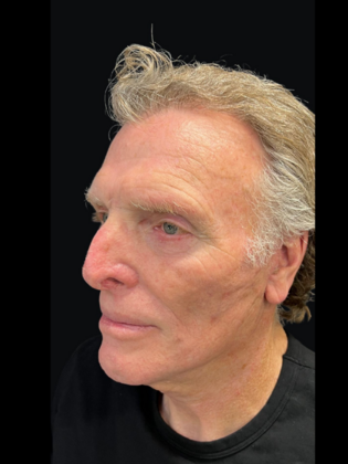Blepharoplasty: Blepharoplasty 5 - After