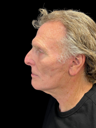 Blepharoplasty: Blepharoplasty 5 - After