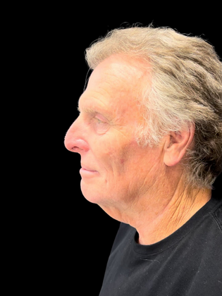 Blepharoplasty: Blepharoplasty 5 - Before