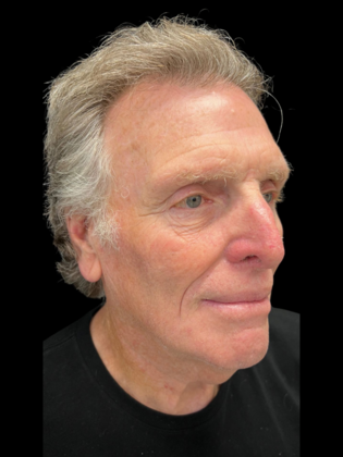 Blepharoplasty: Blepharoplasty 5 - Before