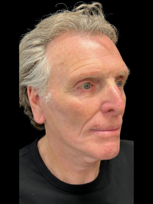 Blepharoplasty: Blepharoplasty 5 - After