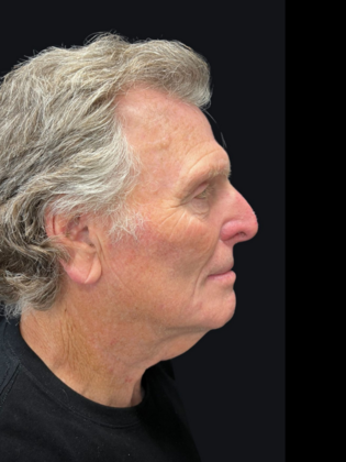 Blepharoplasty: Blepharoplasty 5 - Before
