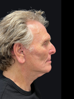 Blepharoplasty: Blepharoplasty 5 - After