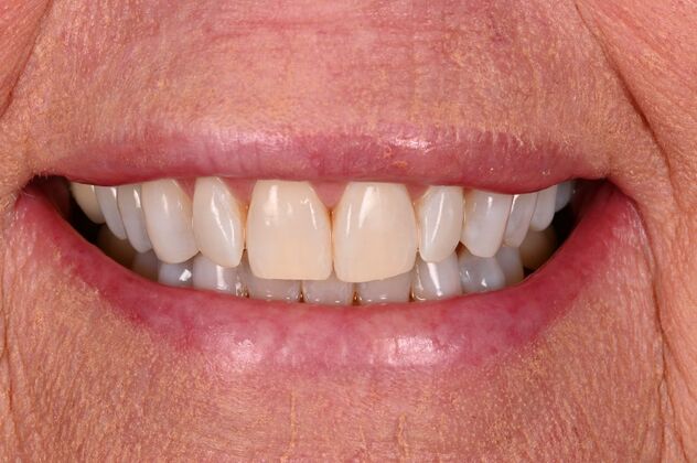 Before and Afters: Case 1 - KöR Teeth Whitening - After