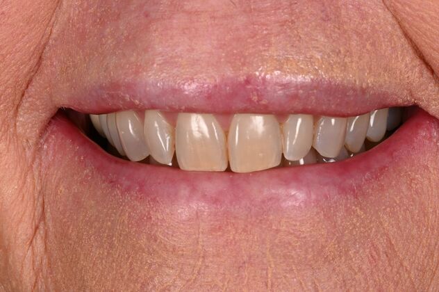Before and Afters: Case 1 - KöR Teeth Whitening - Before
