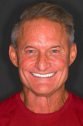 Before and Afters Case 2 - Smile Makeover - After