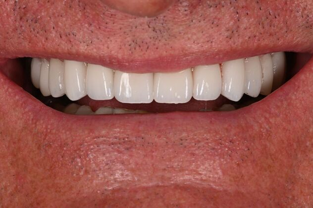 Before and Afters: Case 2 - Smile Makeover - After