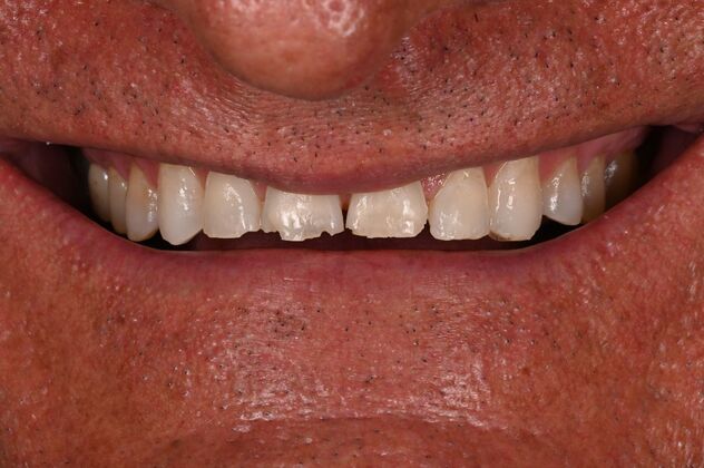 Before and Afters: Case 2 - Smile Makeover - Before