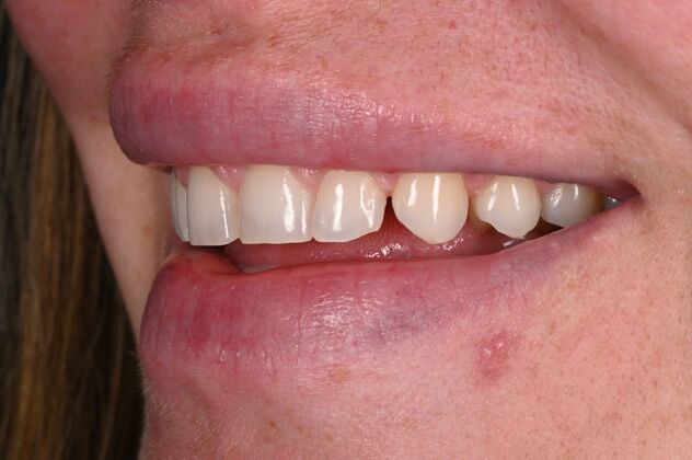 Before and Afters: Case 3 - Ceramic Veneers - Before