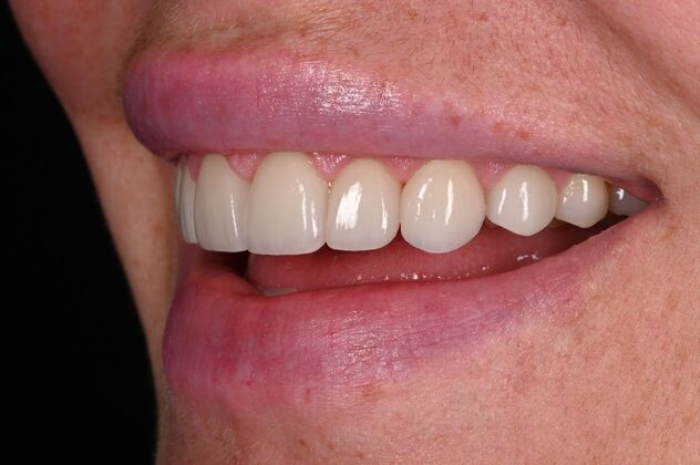 Before and Afters: Case 3 - Ceramic Veneers - After