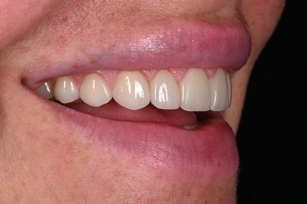 Before and Afters: Case 3 - Ceramic Veneers - After
