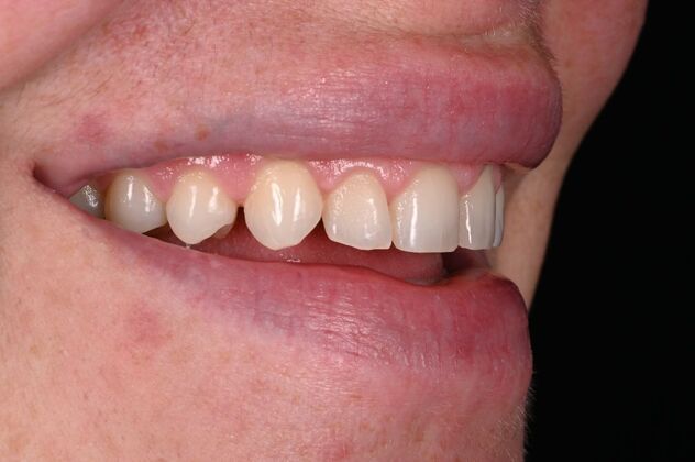 Before and Afters: Case 3 - Ceramic Veneers - Before