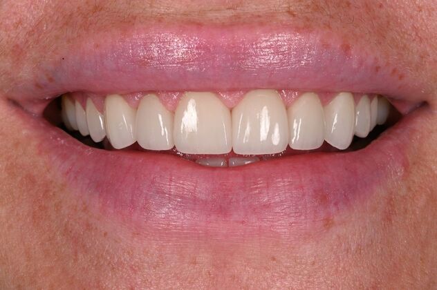 Before and Afters Case 3 - Ceramic Veneers - After